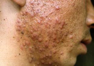 痤疮粉刺的治疗方法