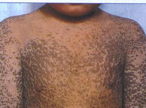 鱼鳞皮肤怎么回事