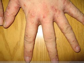 天津疥疮的治疗方法有哪些