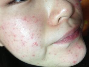 天津痤疮的治疗方法