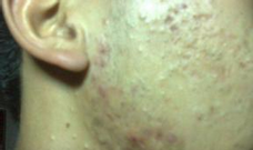 如何治疗脸上痤疮