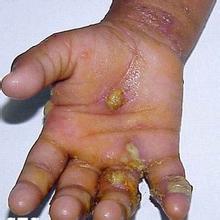 疥疮是怎么引起的