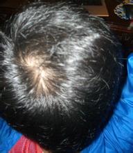 男人掉头发的原因