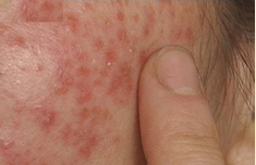 荨麻疹能治疗吗